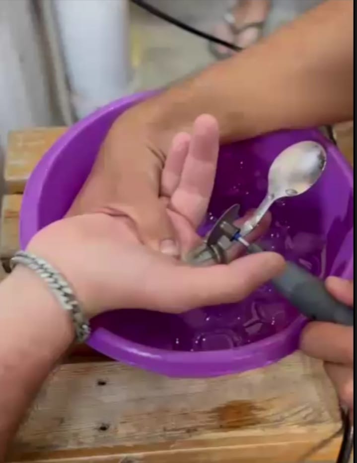 צילום חילוץ הטבעת מהאצבע